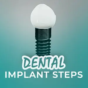 4 Steps Of Dental Implant Procedure