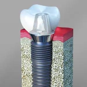 Your Guide to Dental Implants: Procedure, Cost, Types, and More