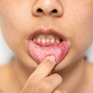 Picture of a woman with receding gums