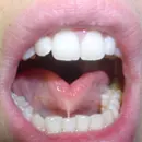 Tongue-tie | Tongue-tie Treatment | Cary and Raleigh, NC